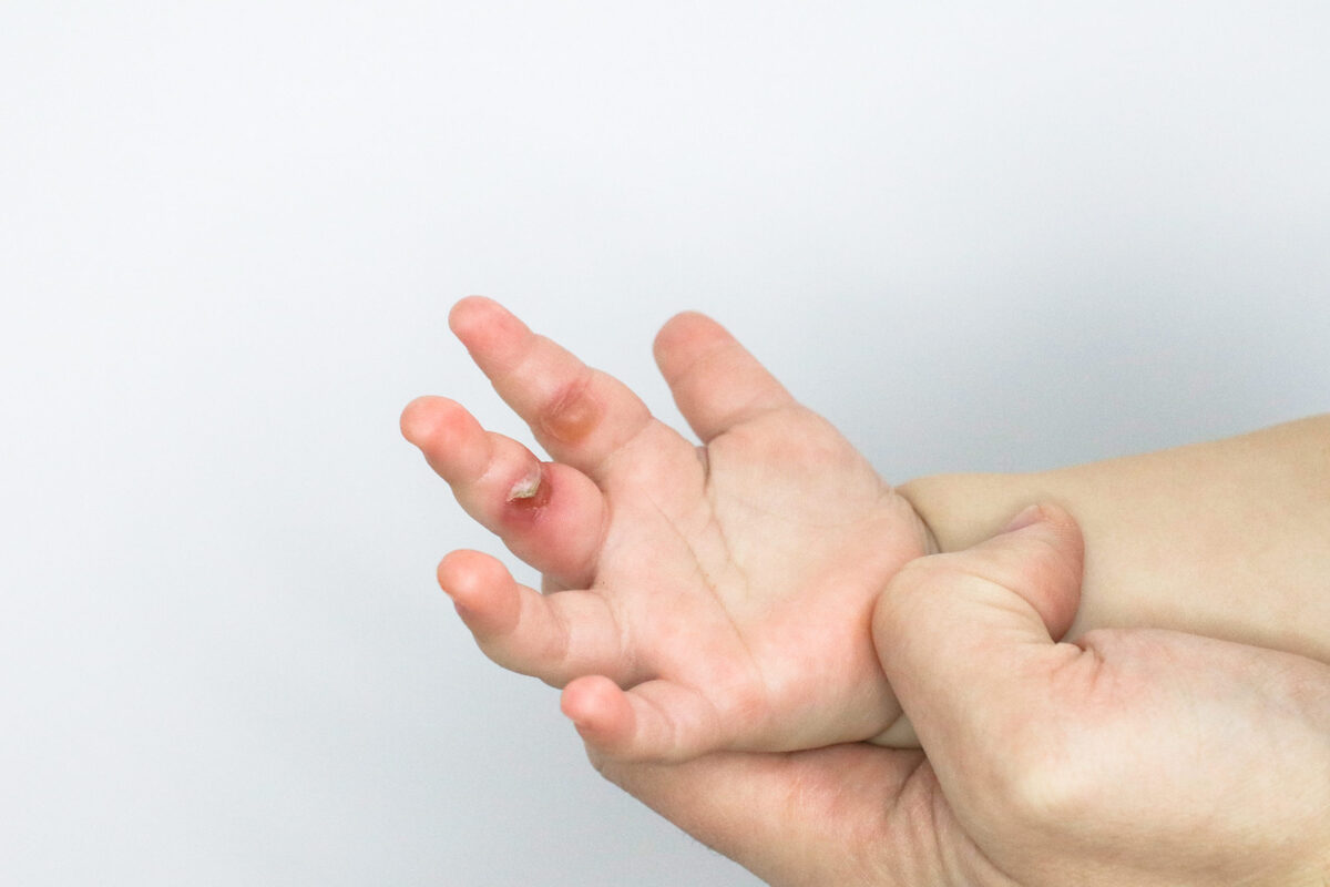 Bebé indígena de 10 meses sufre quemaduras con agua hirviendo en resguardo kogui 