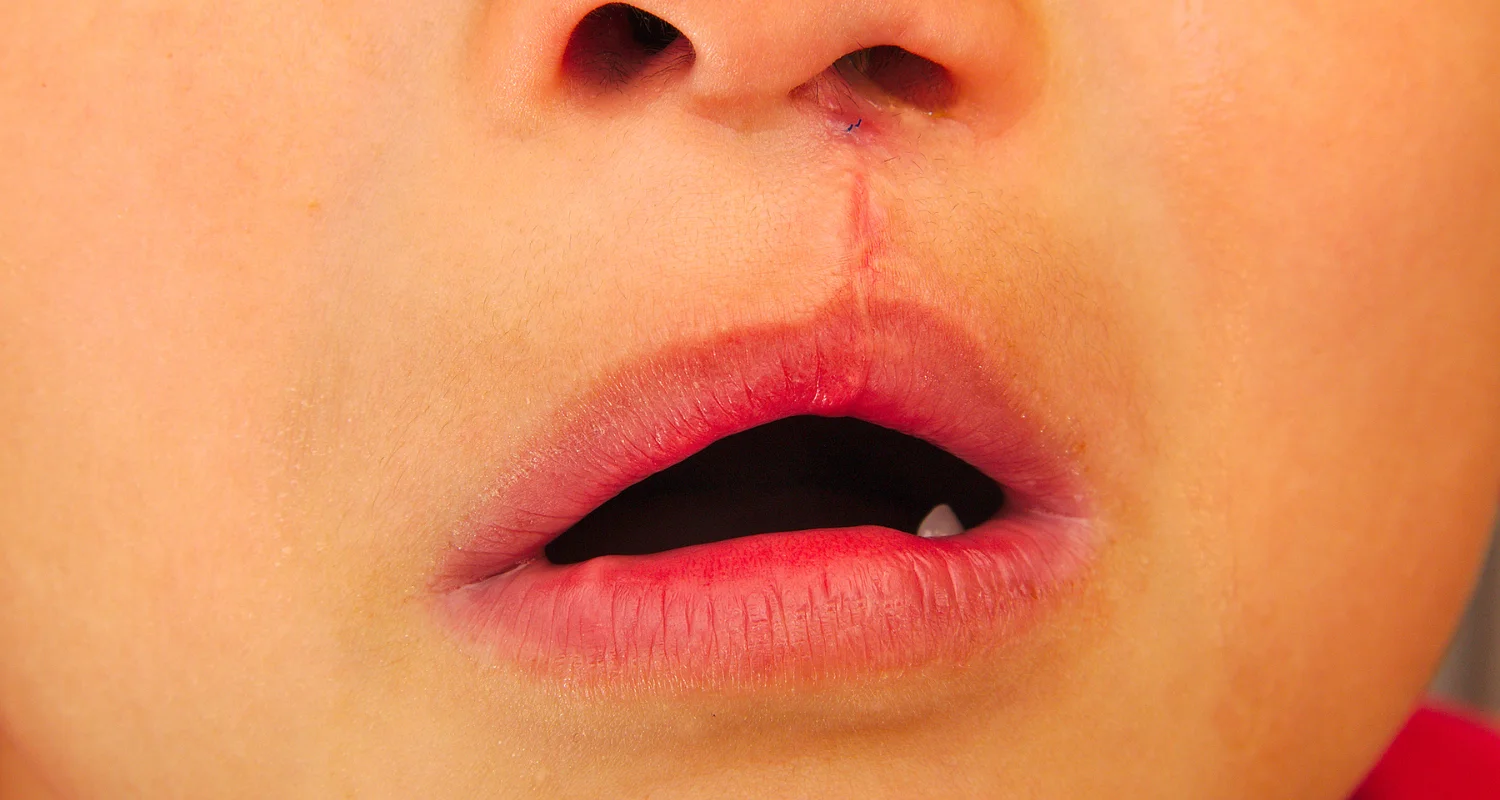 Con el apoyo de un equipo multidisciplinario, este niño recibe atención integral que va más allá de la cirugía, acompañándolo en cada etapa. Foto: worldofdentistry.org.