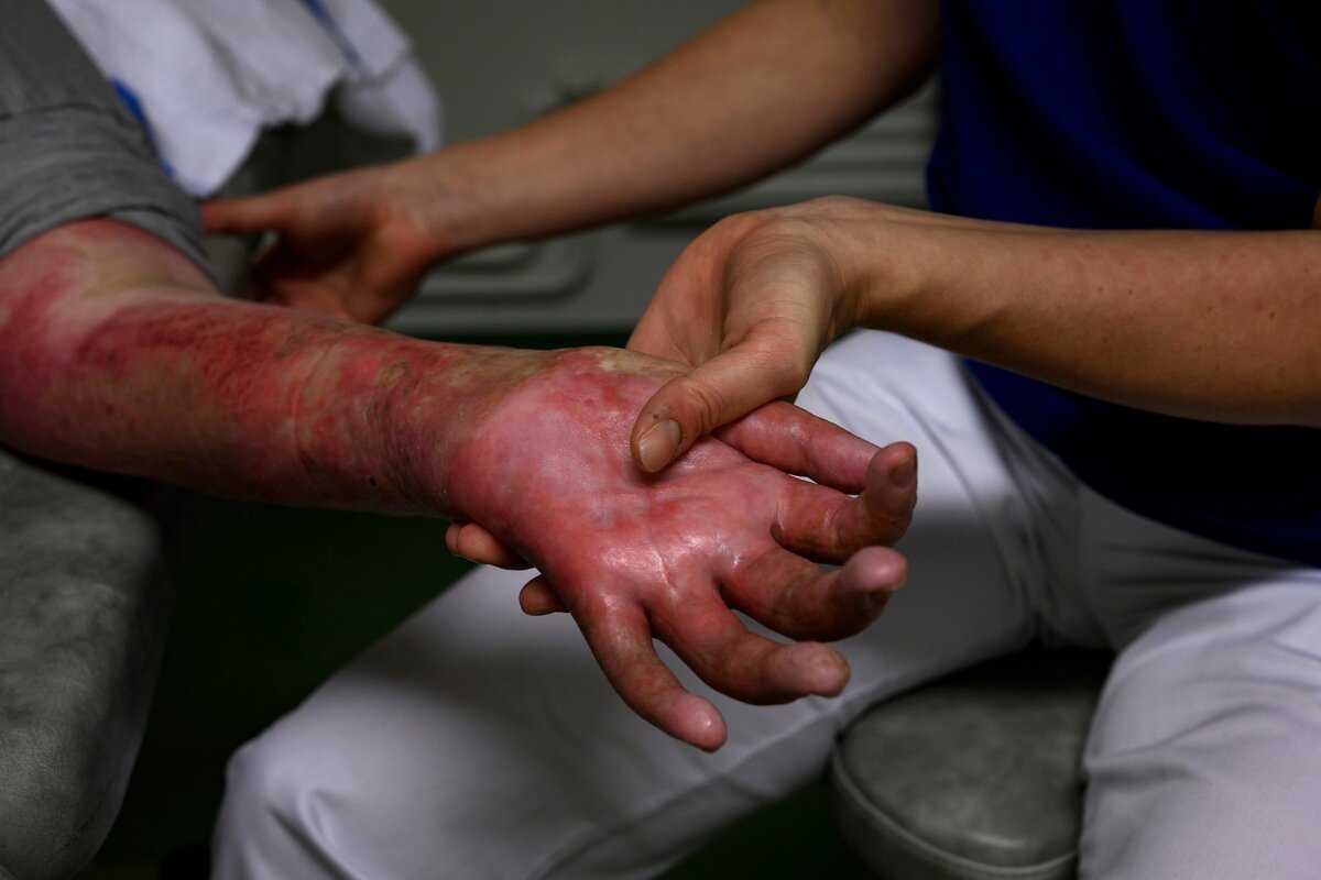Niños quemados en invasión de Valledupar claman ayuda para su recuperación
