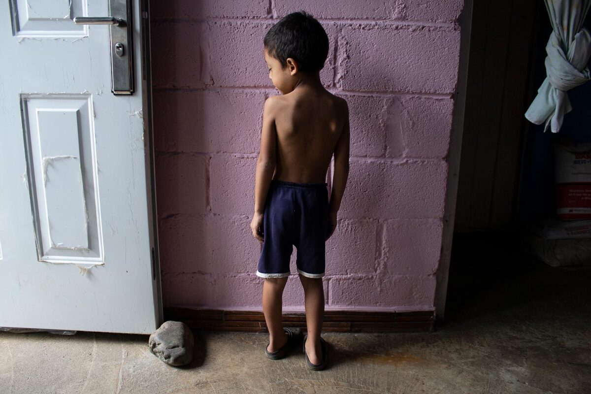 Niño menor de cinco años afectado por desnutrición aguda en el Cesar, departamento que enfrenta un aumento preocupante de casos infantiles debido a la pobreza, la inseguridad alimentaria y la falta de acceso a servicios básicos de salud y nutrición. Foto: Connectas.org.