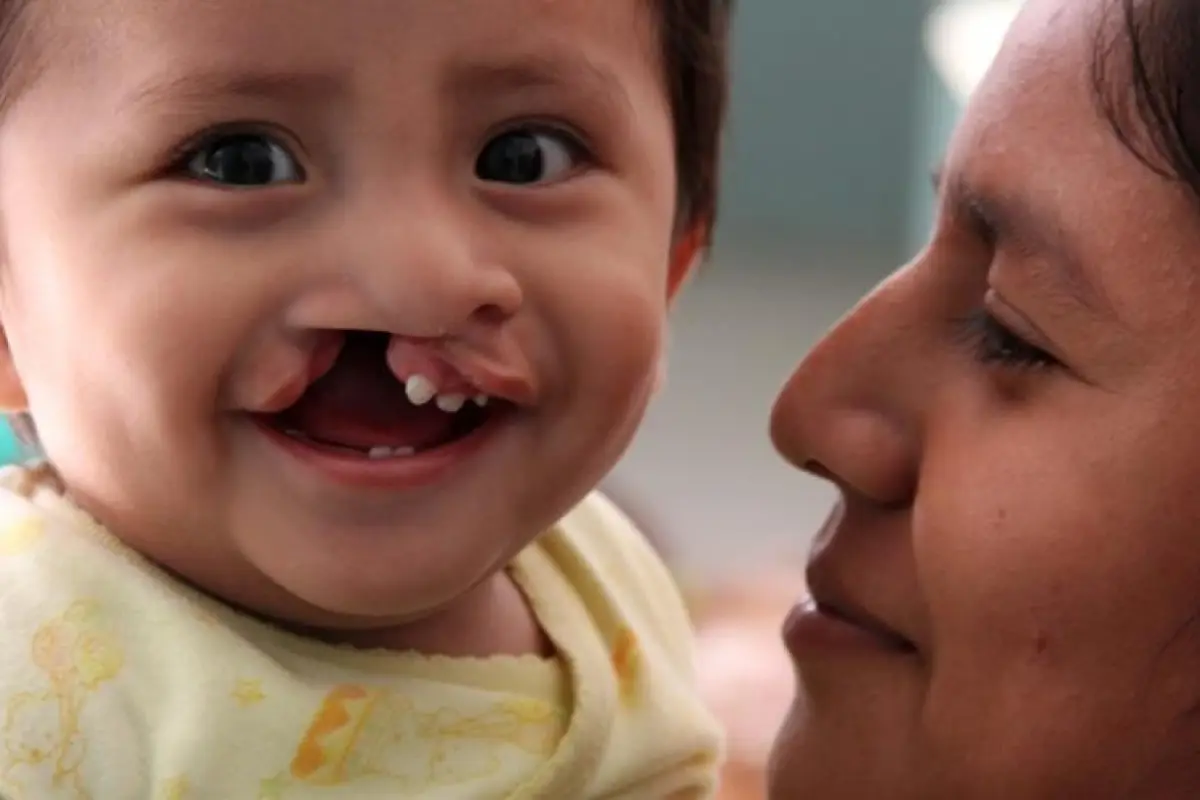 Los niños con labio leporino sonríen gracias a Operación Sonrisa. Foto: Club Rotario Guatemala.
