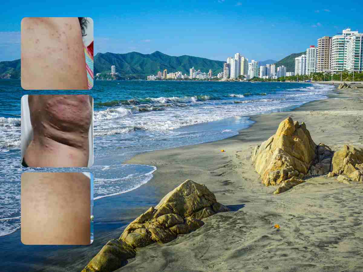 Alerta en Santa Marta por afecciones en la piel de las personas que visitan las playas