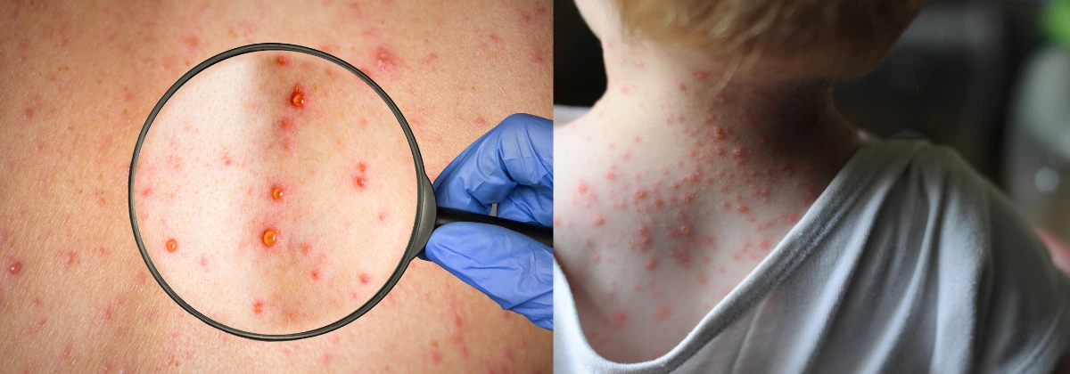 Aíslan a 18 estudiantes por brote de varicela en colegio de Aguachica